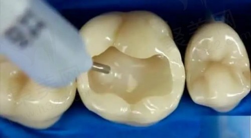 贵阳口腔医院补牙、拔牙价格