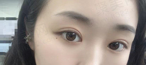 双眼皮手术<span style=