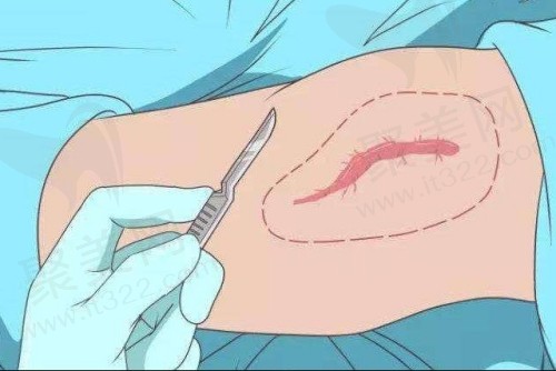 上海健桥医院疤痕修复技术的优势