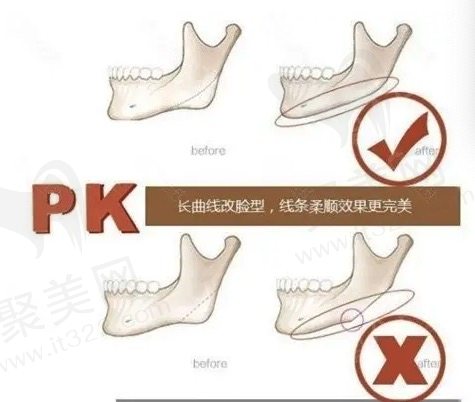 切下颌角后遗症