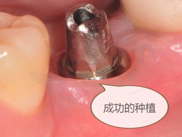 周振文做种植牙怎么样