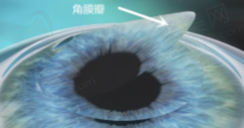 飞秒近视手术优势详情