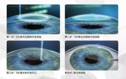 上海和平眼科医院屈光矫正手术价格