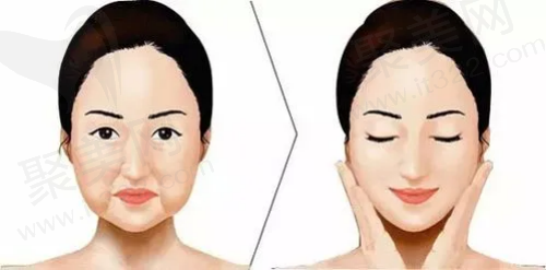 埋线提升面部可以维持多久