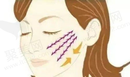 埋线提升面部有什么副作用