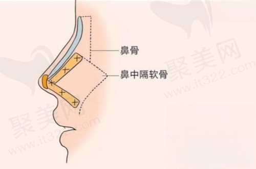 广州壹加壹李明医生做鼻子好吗