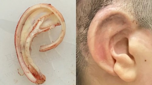 李超耳再造技术怎么样