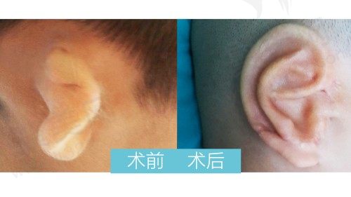 重庆华美整形耳再造公益减免费用