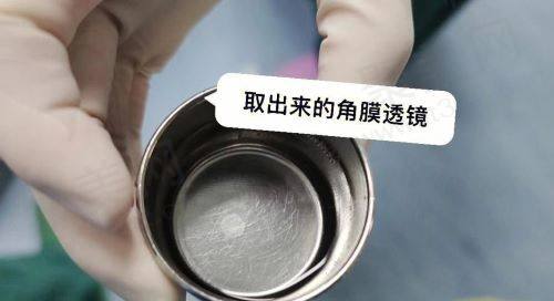 全飞秒激光适合什么样的人群