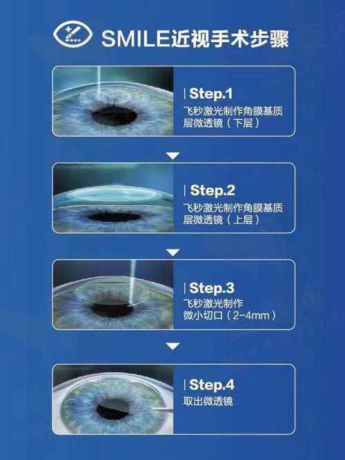 郑州华厦眼科医院医护术后对比