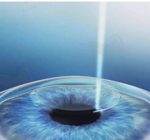 北京熙仁眼科医院近视手术多少钱