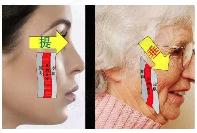 smas筋膜提升保持几年