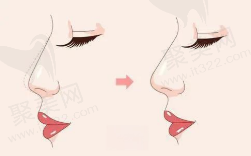 上海伯思立整形医院隆鼻技术好