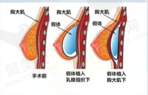 上海伯思立整形医院隆胸技术好