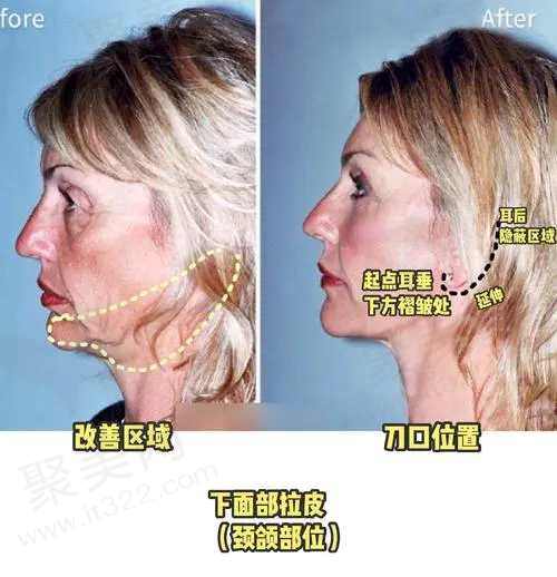 面部小拉皮手术需要多少钱一次