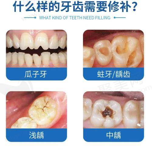 美国3M树脂补牙有什么优势