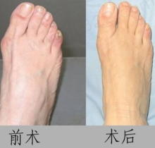 拇指外翻术前术后对比