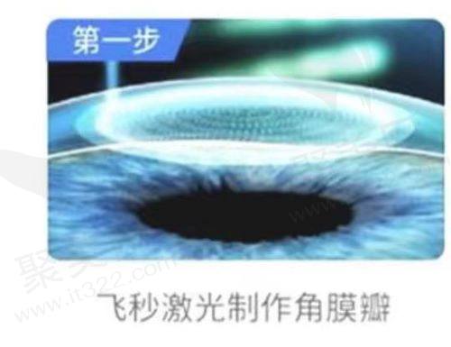 激光近视手术的副作用有哪些
