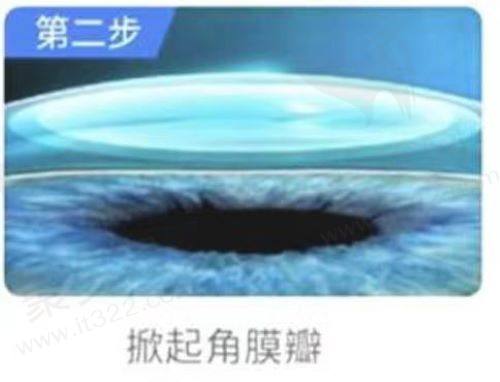 哪些人群不适合做激光激光手术