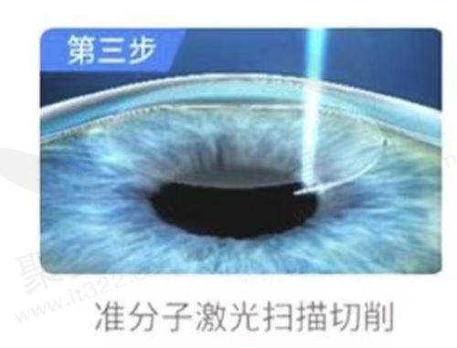 哪些人群不适合做激光激光手术