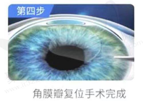激光近视手术术后怎么护理