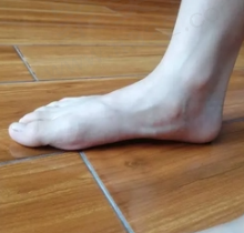 扁平足
