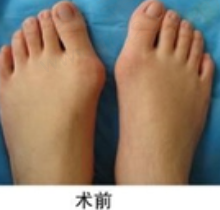 手术前拇指外翻