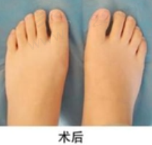 拇指外翻术后