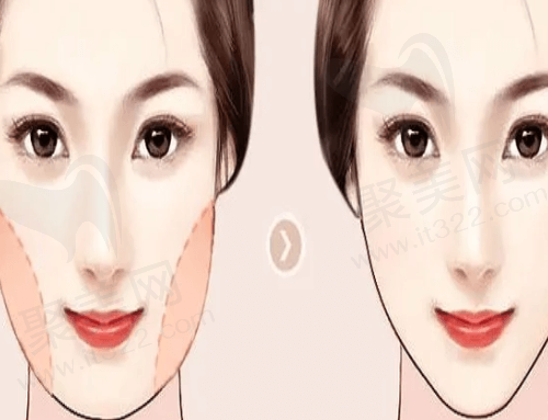 面部吸脂<span style=