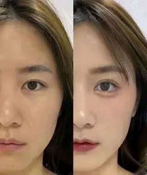 北京嘉禾医疗美容医院做双眼皮术后评价