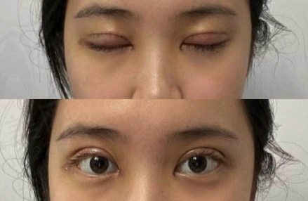 广州曙光医学美容医院双眼皮