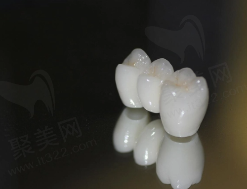 不建议门牙做全瓷牙