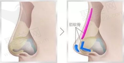 肋软骨隆鼻适合哪些人