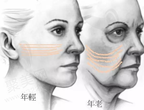 什么人不适合做埋线提升