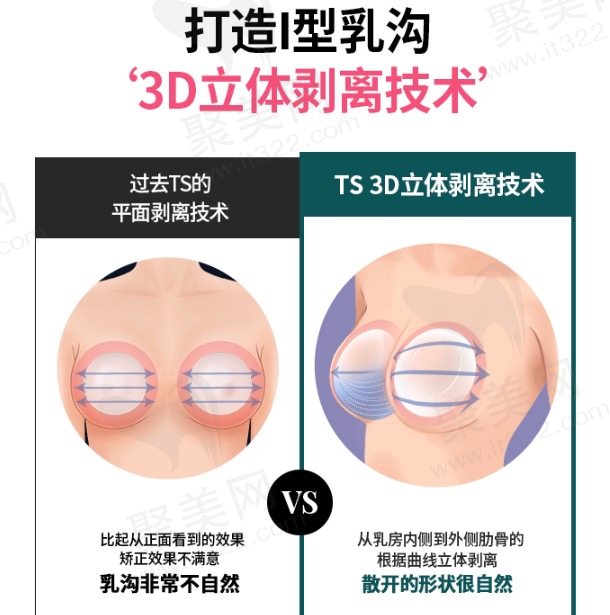 韩国TS整形医院隆胸优势有哪些