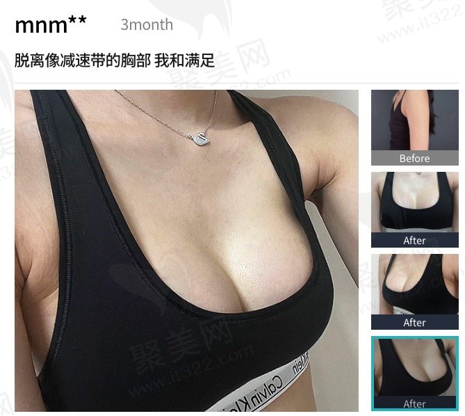 韩国TS医院MOTIVA隆胸的手术前后对比