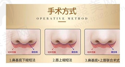 人中缩短手术是否会留疤