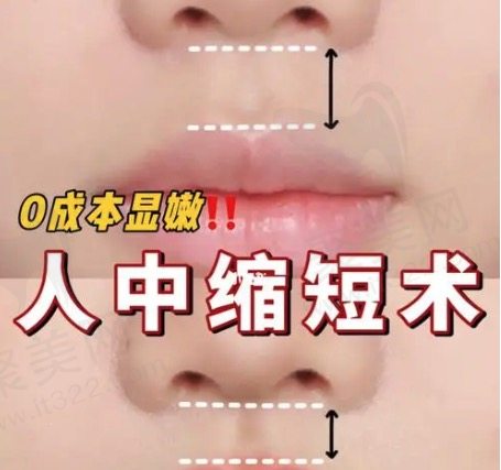 人中缩短术前后对比