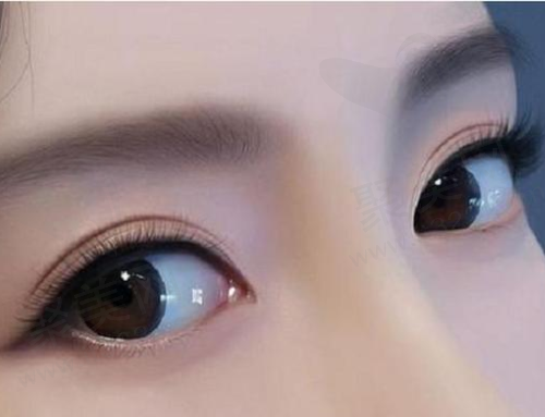 临沂卫康整形美容医院双眼皮技术怎么样