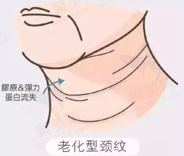 颈纹嗨体注射一次多少钱？