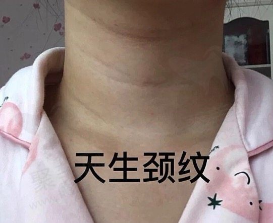 颈纹嗨体注射能保持多久？