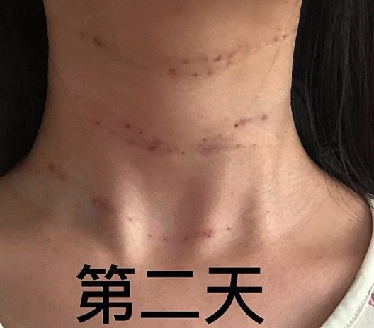  脖子好多颈纹怎么办