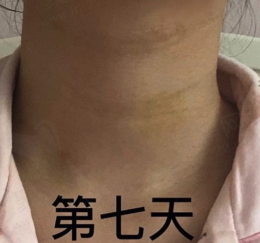 打嗨体去颈纹有风险吗