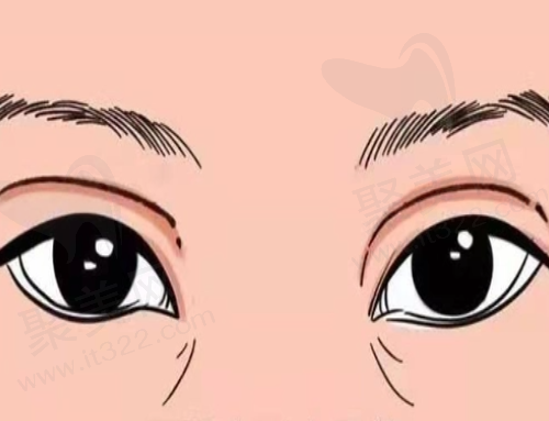 北京正美医疗美容医院高难度双眼皮修复怎么样 北京正美医疗美容医院高难度双眼皮修复怎么样