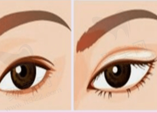 郑永生双眼皮修复怎么样 郑永生双眼皮修复怎么样