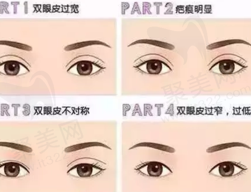 双眼皮修复 双眼皮修复