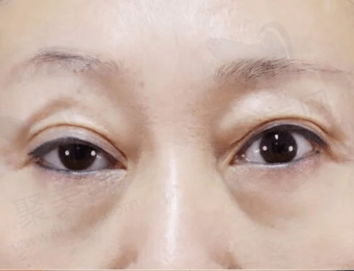 双眼皮修复前 双眼皮修复前