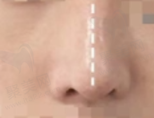 歪鼻矫正后 歪鼻矫正后