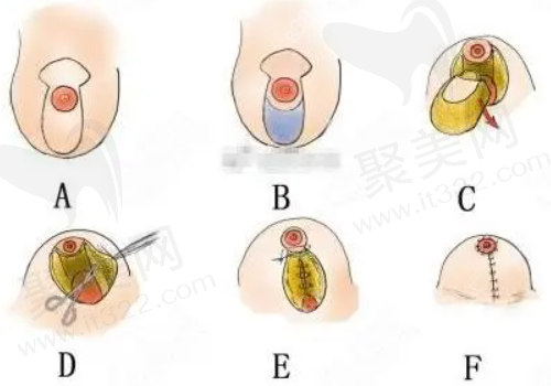 棒棒糖乳房缩小步骤