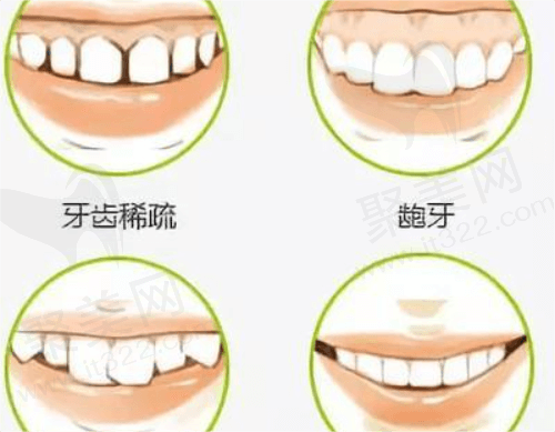 时代天使隐形矫正有哪些好处？